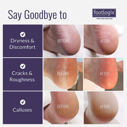 Footlogix - Callus Softener Set